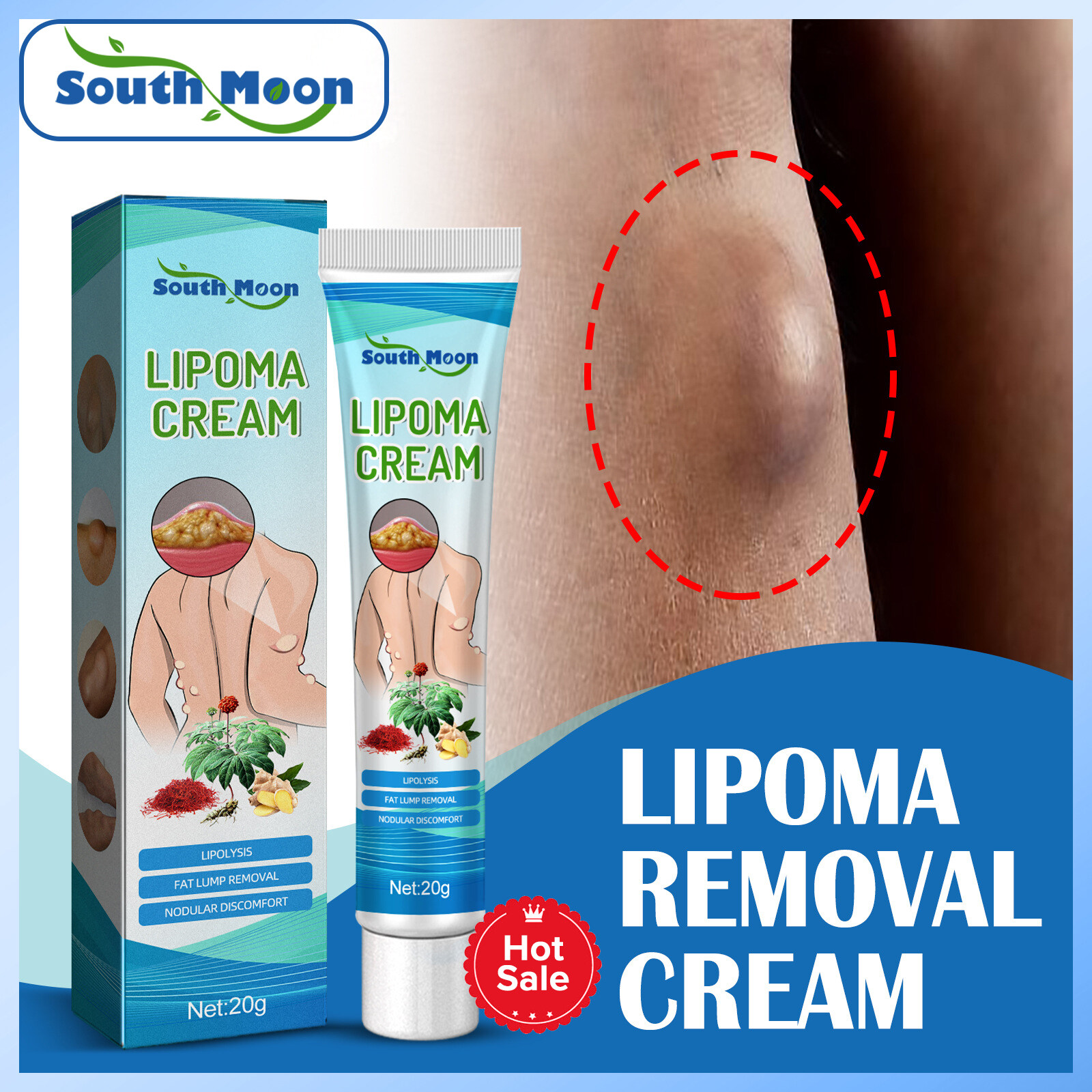【 Hot Sale 】 South Moon Lipoma Removal Cream Lipolysis Fat Lump Relieve Plaster Skin Swelling Ointment Subcutting Lumps