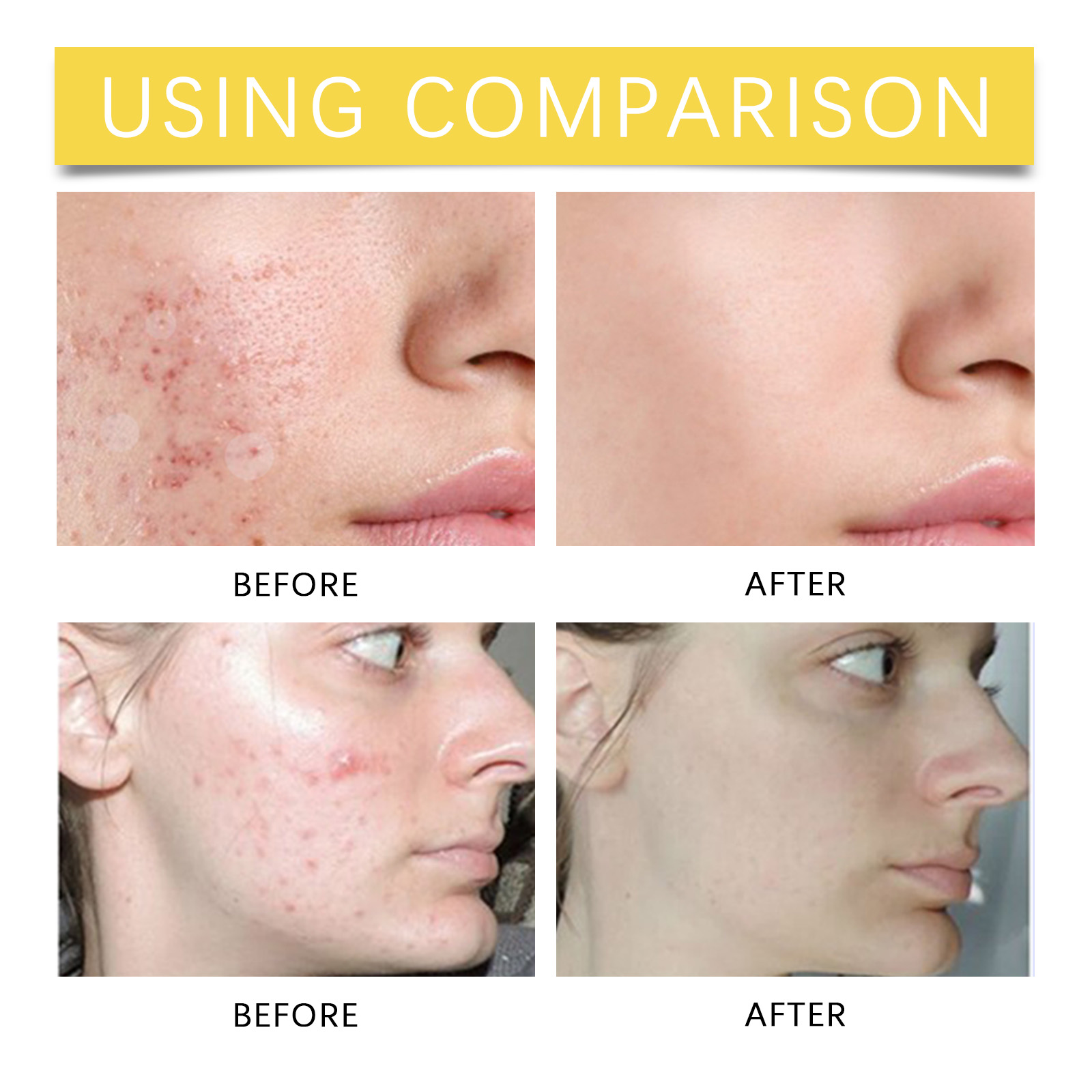 Invisible Acne Patch For Clear Skin Face Care Home Beauty Device_voghion.com