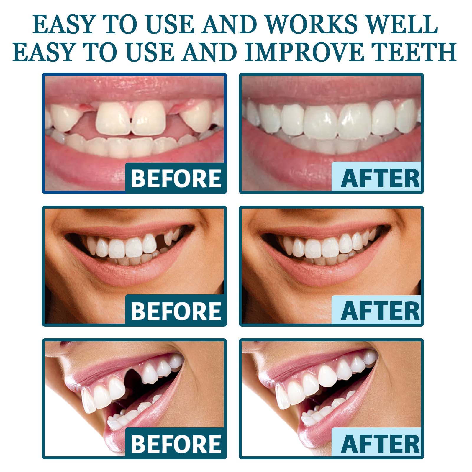 EELHOE Gentle Cosmetic Dental Kit – Anpassbare, aufsteckbare Zahnprothese, nicht-invasive ästhetische Lösung für ein schönes Lächeln, CE-zertifizierte herausnehmbare Prothese_voghion.com