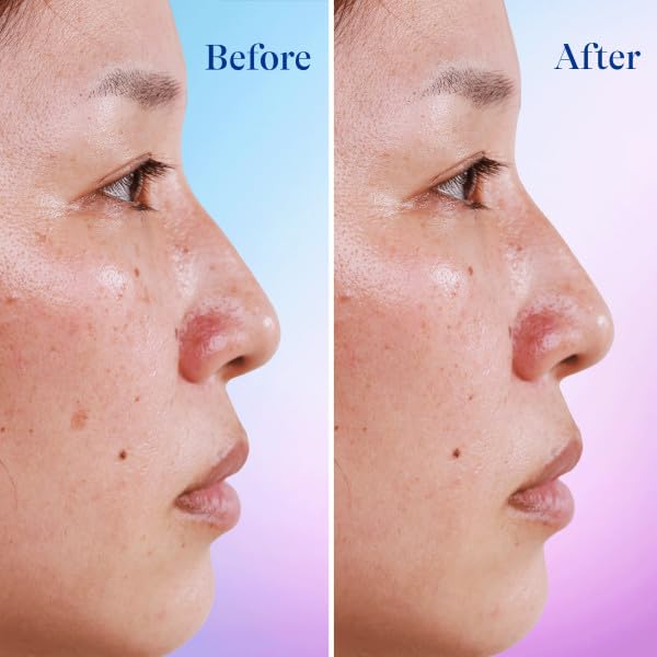 Nuovo siero viso Differin Dark Spot Correcting, cura delicata della pelle per pelli sensibili inclini all'acne_voghion.com