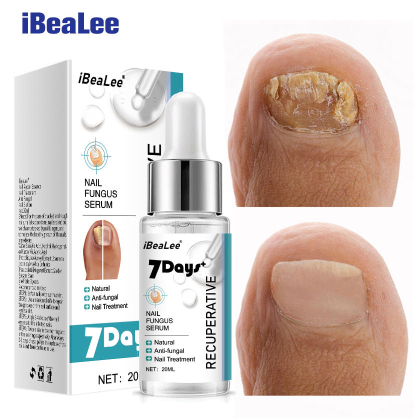 Special Antibacterial Nail Removal Cream Thickening Soft Nails, And Special Solution For Gray Nails
