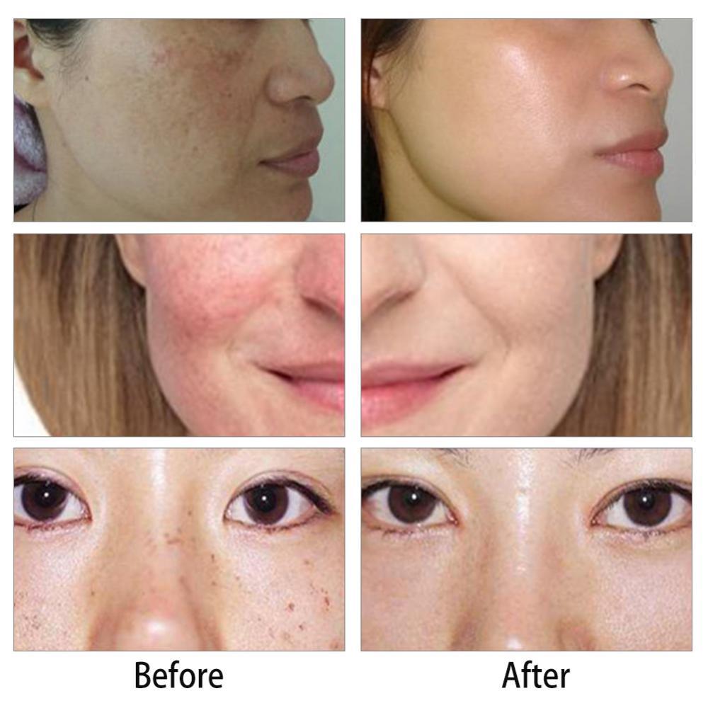 Håndheald Red Light Picosecond Laser Pen Ar Tatovering Fjernelse Melanin Dilute Device + Repair Set - intl_voghion.com