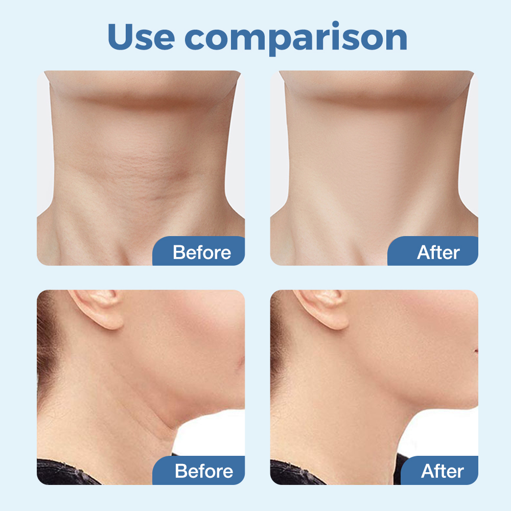 EMS Mikrostrom-Halslifting-Maschine, Nackenmassagegerät, Schönheit, elektrische thermische Rotlichttherapie, Faltenentferner, Anti-Aging-Hautpflege_voghion.com