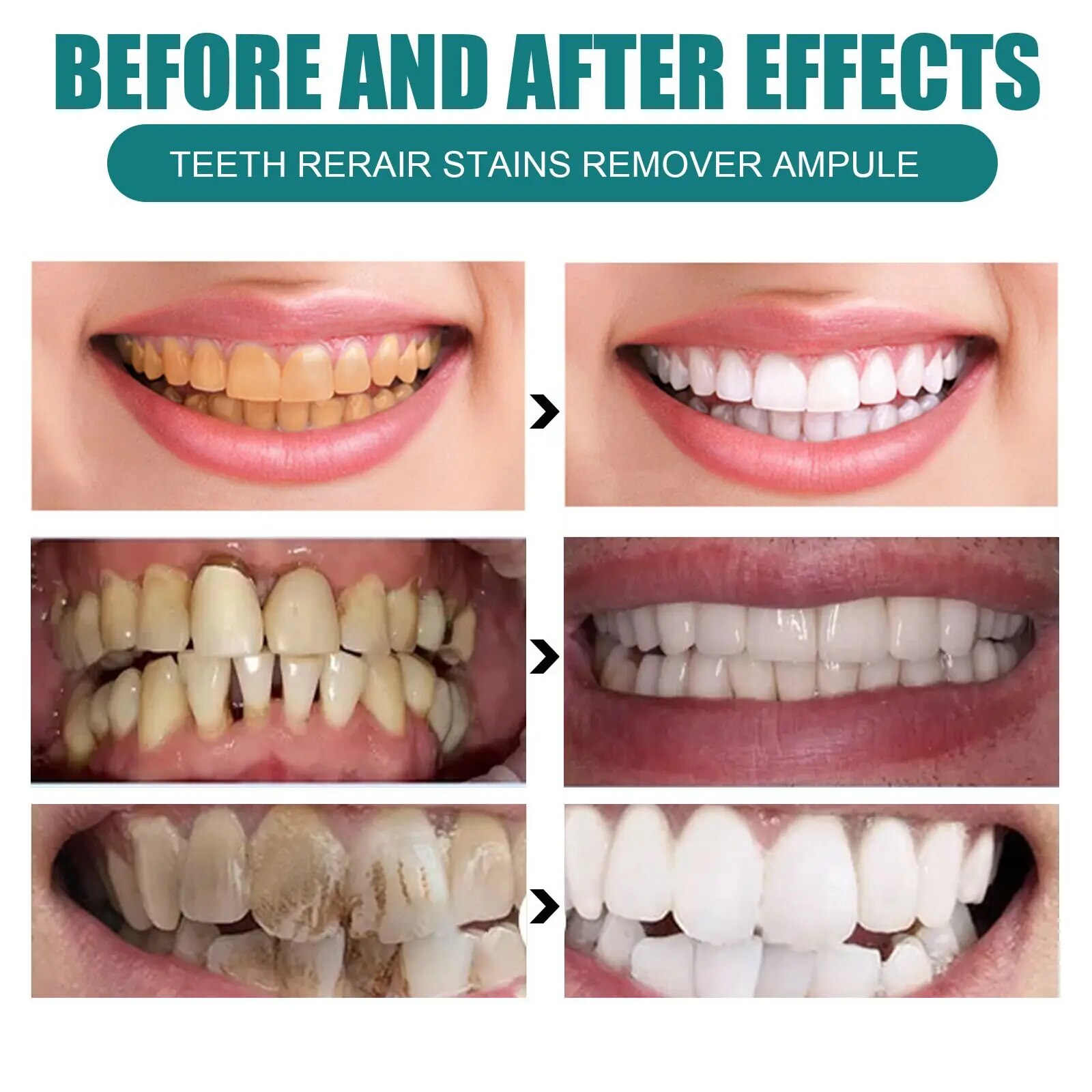 Negozio di bellezza Riparazione Sbiancamento Jaysuing Liquido detergente macchie gialle, le macchie dei denti sono più efficaci_voghion.com