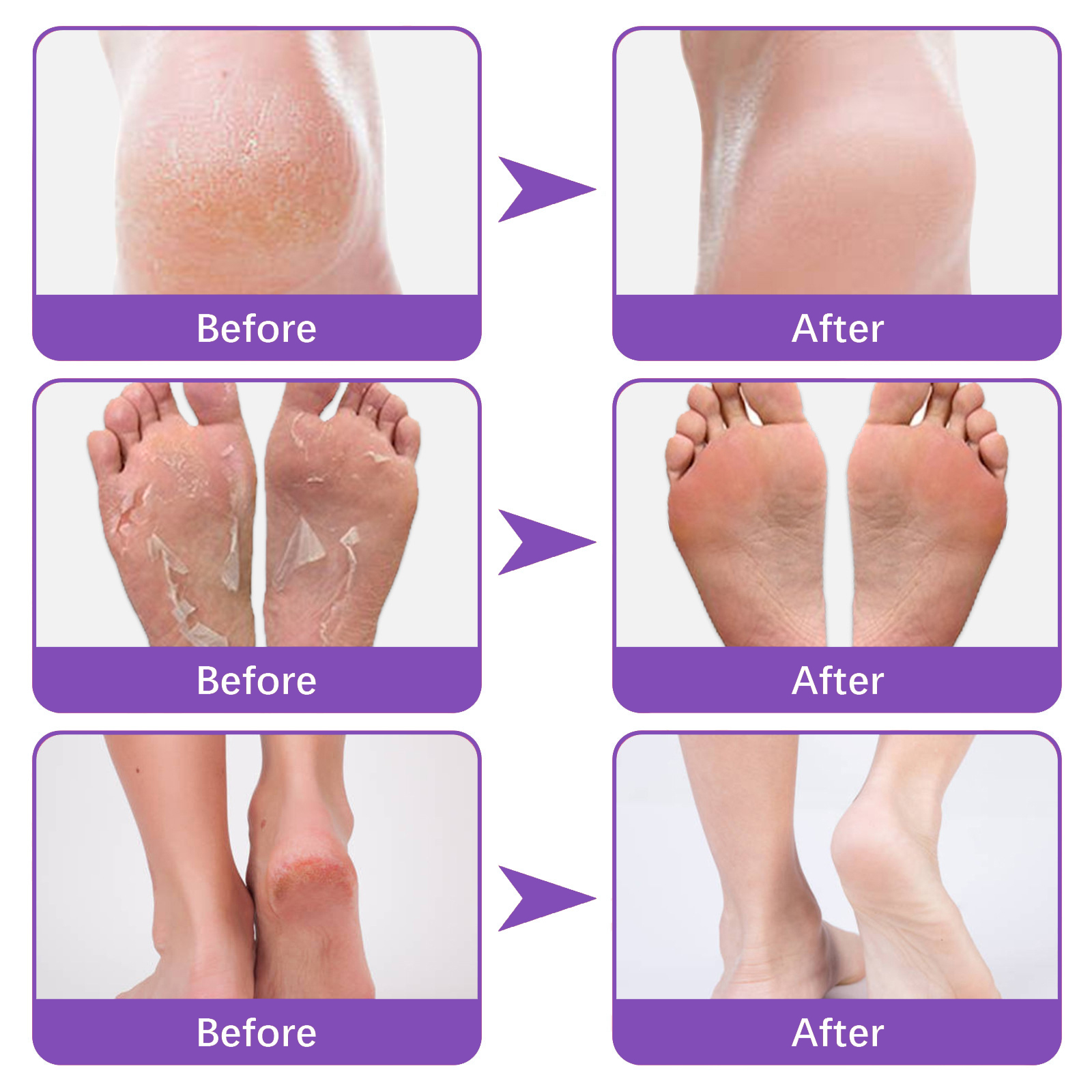 EELHOE Ginger Foot Mask (Box) Foot Moisturizing, Nourishing, Rejuvenating, Exfoliating, Removing Dead Skin, Dry And Cracked Skin Care Foot Mask_voghion.com