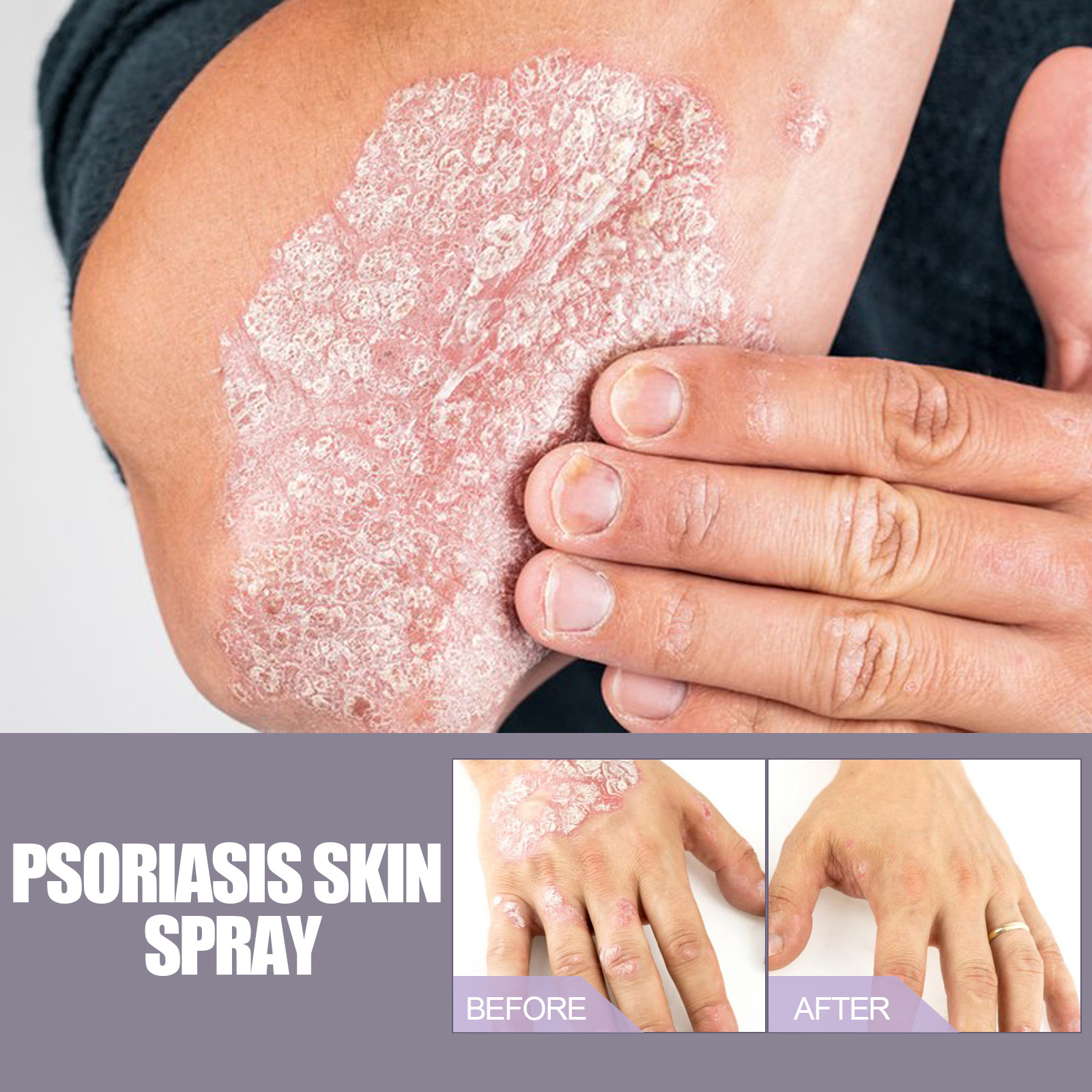EELHOE riparazione del muschio mano-piede per alleviare il prurito e spray per la cura della pelle Jiejia_voghion.com
