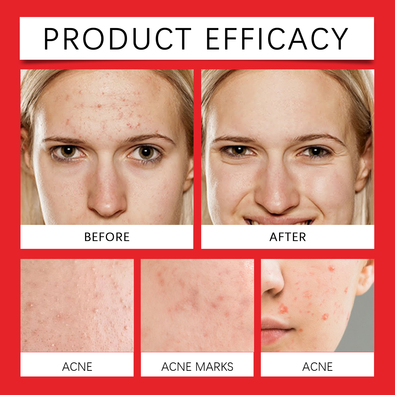 Jaysuing Blemish Acne Patch Clear Acne Face Cover Acne Care Facial Contact Patch_voghion.com