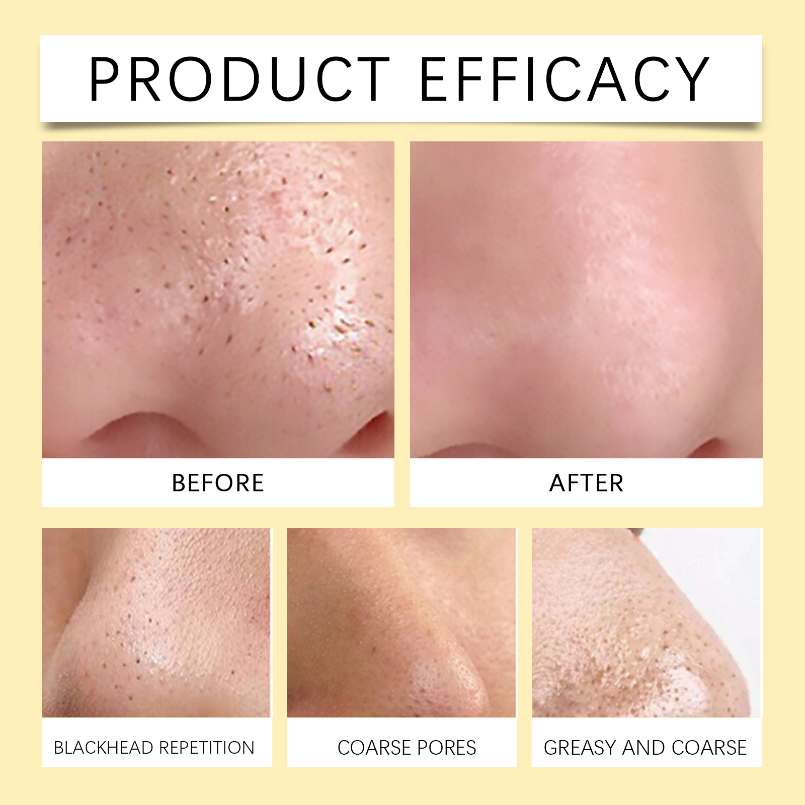 EELHOE Blackhead Cleansing Nose Patch Gently Cleanses T Zone Pores, Acne Moisturizes Skin And Tears Nose Mask_voghion.com